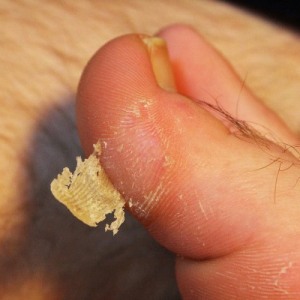 Как избавиться от сухой мозоли на пальце ноги?
