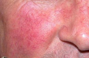 Красные пятна на лице образуются из-за аллергической реакции после употребления алкоголя