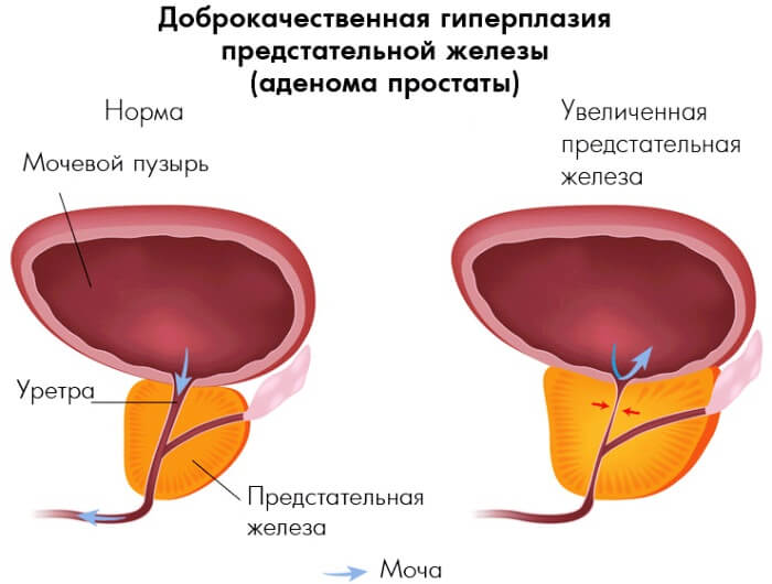 объем предстательной железы при аденоме 