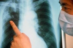 Симптомы и лечение закрытой формы туберкулеза