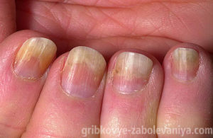 Онихолизис на ногтях руки