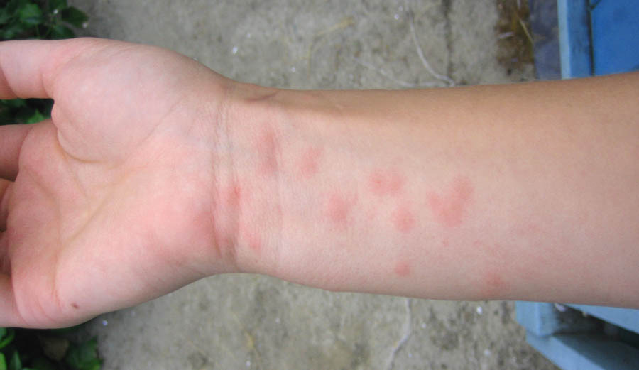 Аллергическая сыпь на руках как выглядит на фото и что делать,Post navigation