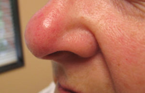 Красное пятно на носу говорит о кожных заболеваниях