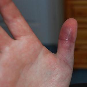 Неотложная помощь и способы терапии при ушибе пальцев на руке
